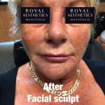 Royal-Aesthetics-Facial-Sculpting-1-After