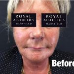 Royal-Aesthetics-Facial-Sculpting-1-Before