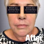 Royal-Aesthetics-Facial-Sculpting-10-After