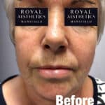 Royal-Aesthetics-Facial-Sculpting-10-Before
