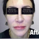 Royal-Aesthetics-Facial-Sculpting-13-After