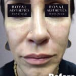 Royal-Aesthetics-Facial-Sculpting-13-Before