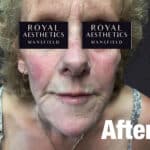 Royal-Aesthetics-Facial-Sculpting-14-After