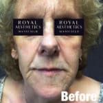 Royal-Aesthetics-Facial-Sculpting-14-Before