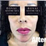 Royal-Aesthetics-Facial-Sculpting-15-After