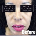 Royal-Aesthetics-Facial-Sculpting-15-Before