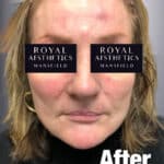 Royal-Aesthetics-Facial-Sculpting-16-After