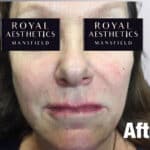 Royal-Aesthetics-Facial-Sculpting-17-After