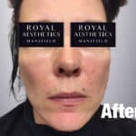 Royal-Aesthetics-Facial-Sculpting-18-After