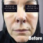 Royal-Aesthetics-Facial-Sculpting-18-Before