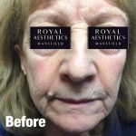 Royal-Aesthetics-Facial-Sculpting-19-Before