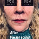 Royal-Aesthetics-Facial-Sculpting-2-After