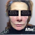 Royal-Aesthetics-Facial-Sculpting-20-After