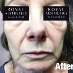 Royal-Aesthetics-Facial-Sculpting-20-Before