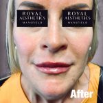 Royal-Aesthetics-Facial-Sculpting-21-After