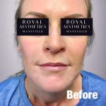 Royal-Aesthetics-Facial-Sculpting-21-Before