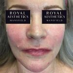 Royal-Aesthetics-Facial-Sculpting-22-After