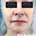 Royal-Aesthetics-Facial-Sculpting-22-Before