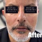 Royal-Aesthetics-Facial-Sculpting-23-After