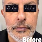Royal-Aesthetics-Facial-Sculpting-23-Before
