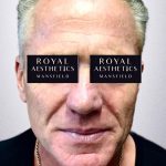 Royal-Aesthetics-Facial-Sculpting-24-Before