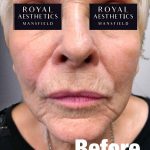 Royal-Aesthetics-Facial-Sculpting-3-Before