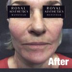 Royal-Aesthetics-Facial-Sculpting-4-After