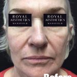 Royal-Aesthetics-Facial-Sculpting-4-Before