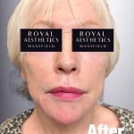 Royal-Aesthetics-Facial-Sculpting-5-After