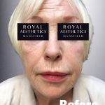Royal-Aesthetics-Facial-Sculpting-5-Before