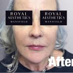 Royal-Aesthetics-Facial-Sculpting-6-After