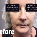 Royal-Aesthetics-Facial-Sculpting-6-Before