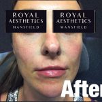 Royal-Aesthetics-Facial-Sculpting-7-After