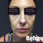 Royal-Aesthetics-Facial-Sculpting-7-Before