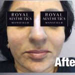 Royal-Aesthetics-Facial-Sculpting-8-After