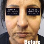 Royal-Aesthetics-Facial-Sculpting-8-Before