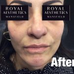 Royal-Aesthetics-Facial-Sculpting-9-After