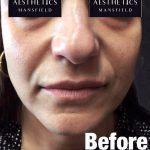 Royal-Aesthetics-Facial-Sculpting-9-Before
