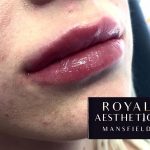 Royal Aesthetics Lip Fillers