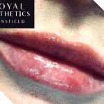Royal Aesthetics Lip Fillers