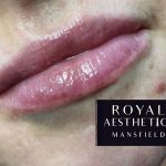 Royal-Aesthetics-Lip-Fillers-15