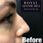 Royal-Aesthetics-Nose-Job-1-Before