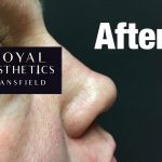 Royal-Aesthetics-Nose-Job-10-After