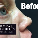 Royal-Aesthetics-Nose-Job-10-Before