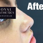 Royal-Aesthetics-Nose-Job-11-After