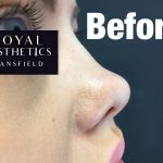 Royal-Aesthetics-Nose-Job-11-Before