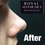 Royal-Aesthetics-Nose-Job-2-After