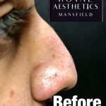 Royal-Aesthetics-Nose-Job-3-Before