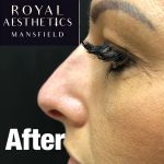 Royal-Aesthetics-Nose-Job-4-After