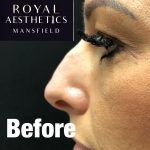 Royal-Aesthetics-Nose-Job-4-Before